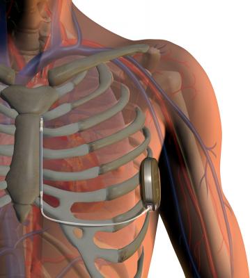 LindaCare, expansion, remote patient monitoring, CIEDs, cardiac implantable electronic devices, United States