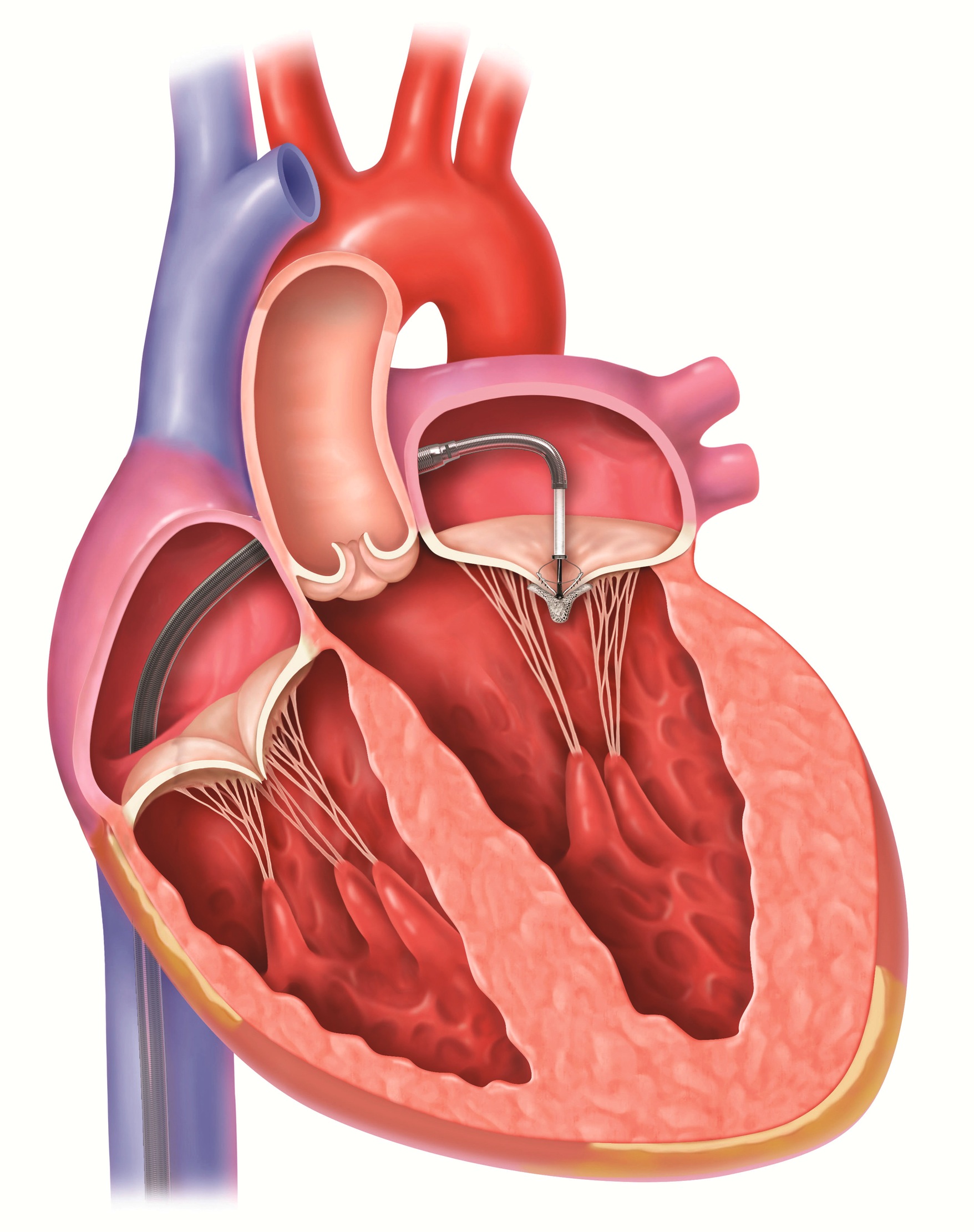 What Is The Survival Rate Of Mitral Valve Surgery