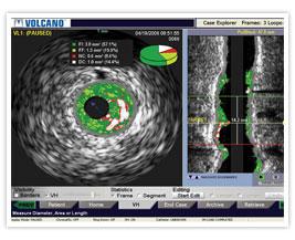 FDA Clears Redesigned IVUS Catheter With Better Visibility | DAIC